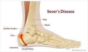 heel pain in kids - severs disease