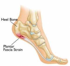 Plantar Fasciitis Causes and Risk Factors Explained